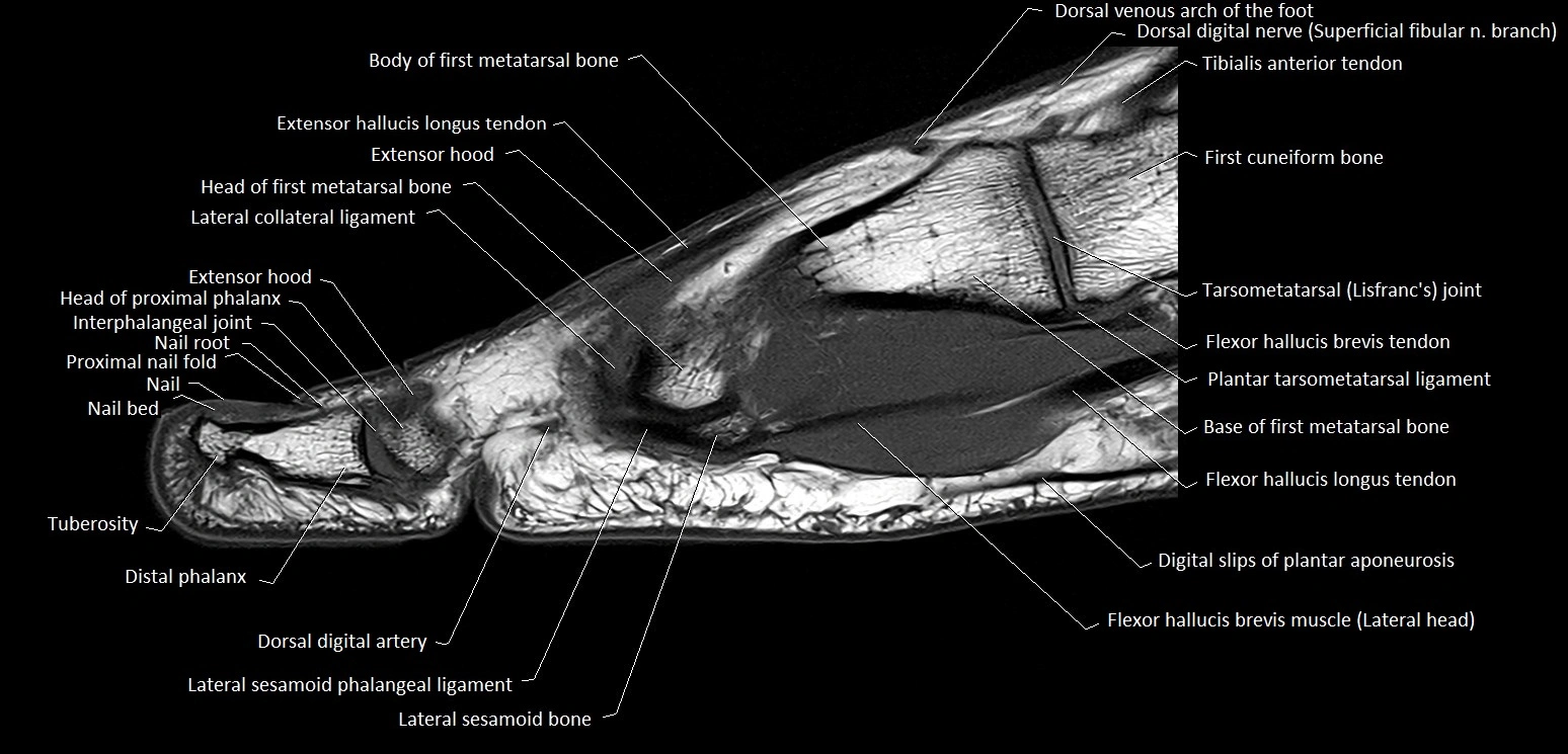 Hallux or big toe sagittal anatomy 3T MRI image 15.webp